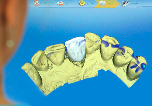 computergestuetzter-zahnersatz